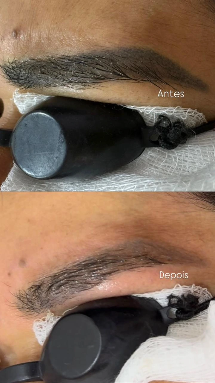 Antes e depois da despigmentação a laser de micropigmentação de sobrancelha