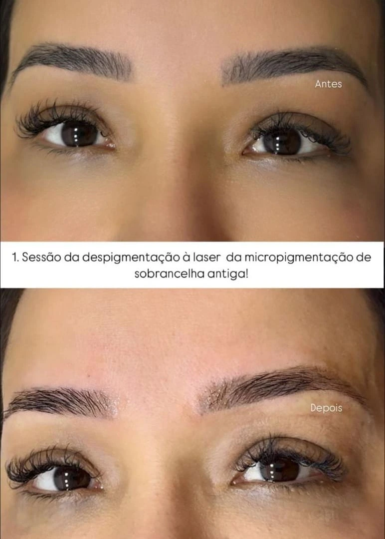 Sobrancelhas antes e depois da primeira sessão de despigmentação a laser