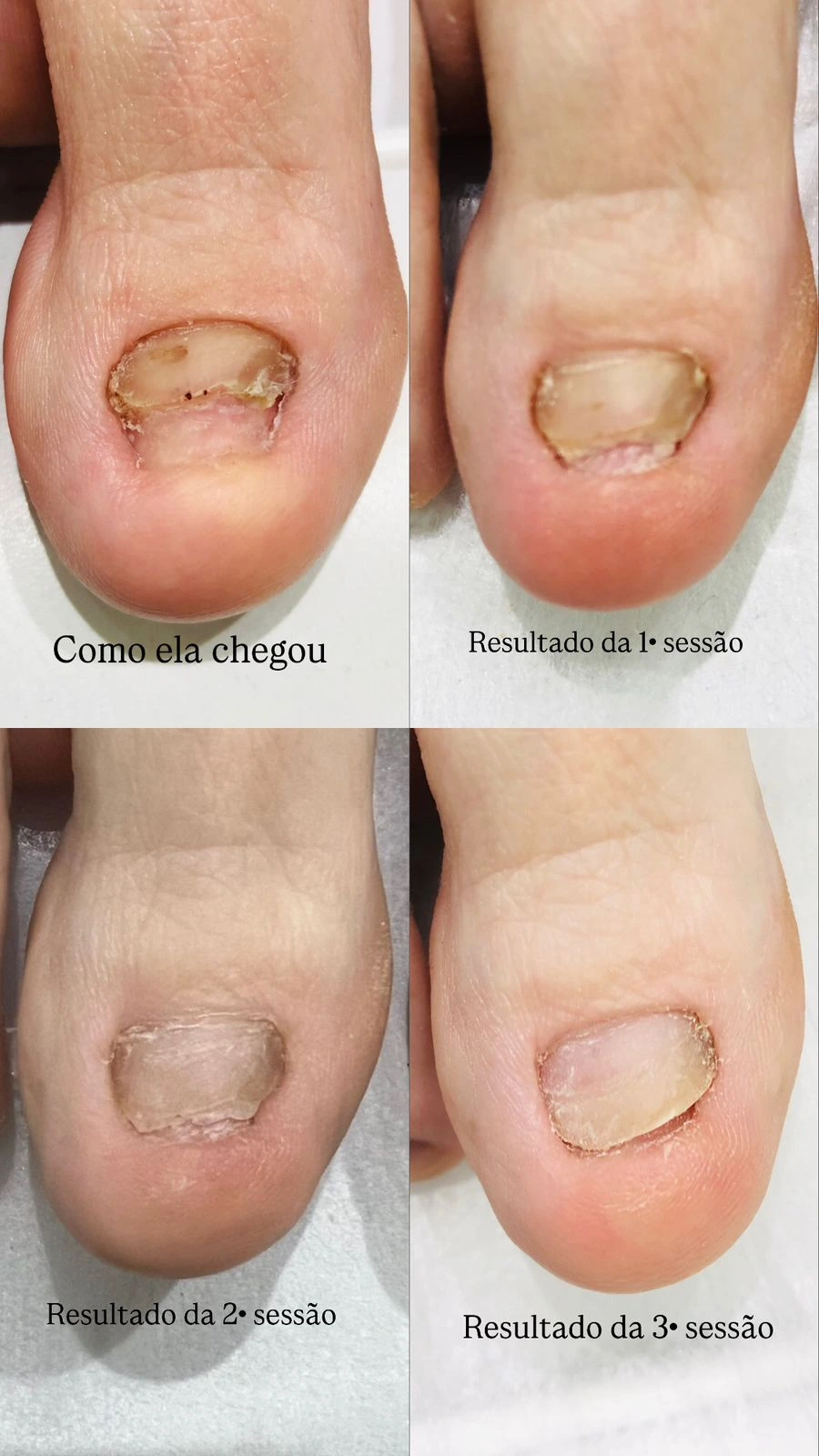 Unha com onicomicose como chegou e após a primeira, segunda e terceira sessão de laser