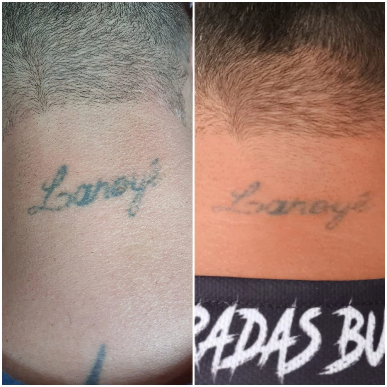 Antes e depois do clareamento a laser de tatuagem de nome na nuca para cobertura