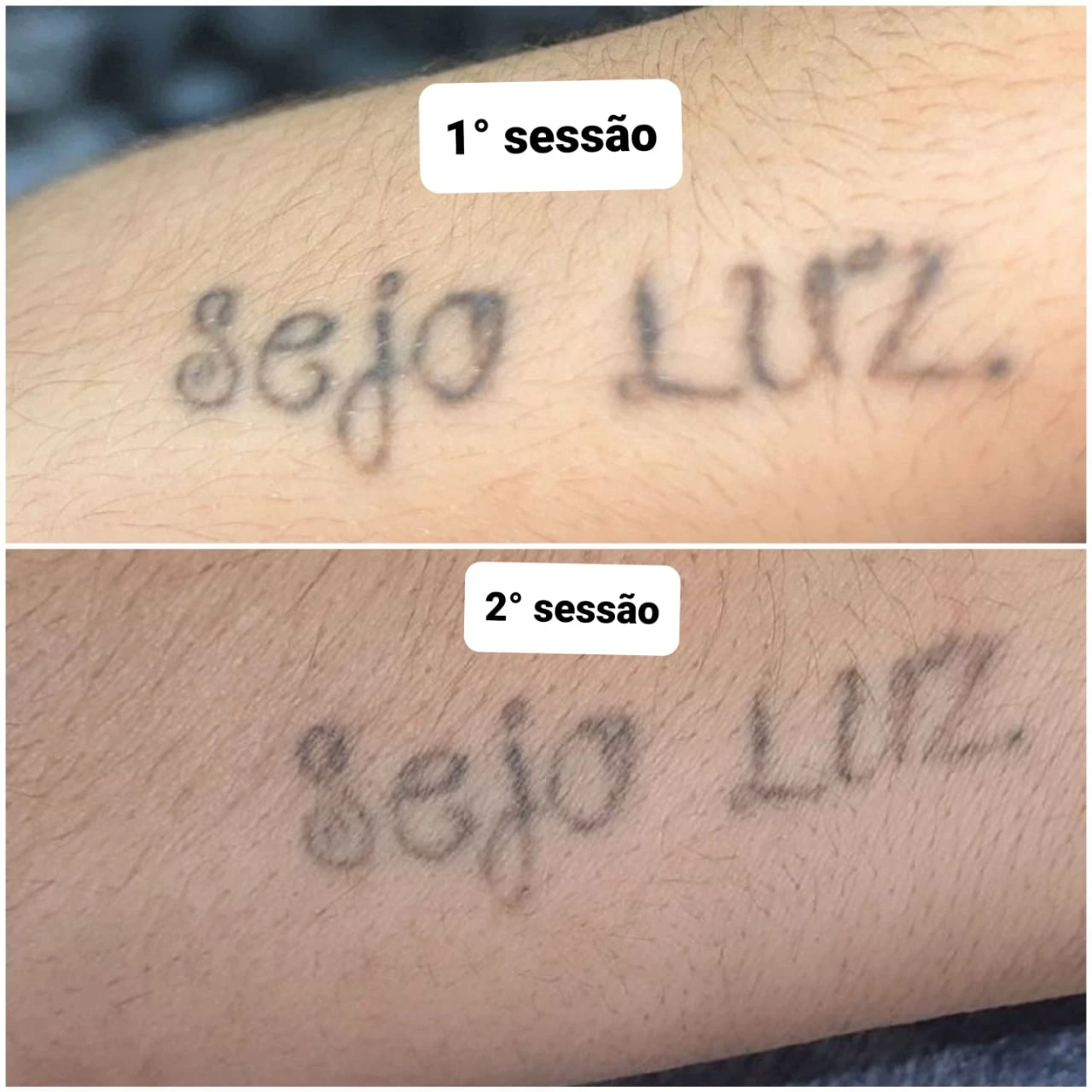 Antes e depois da remoção a laser de tatuagem preta de escrita no antebraço, entre a 1ª e a 2ª sessão