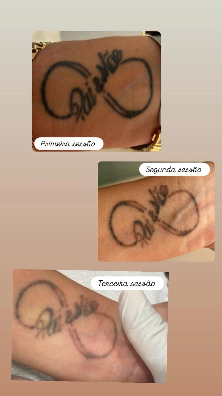Tatuagem preta de infinito clareando ao longo da primeira, segunda e terceira sessão de laser